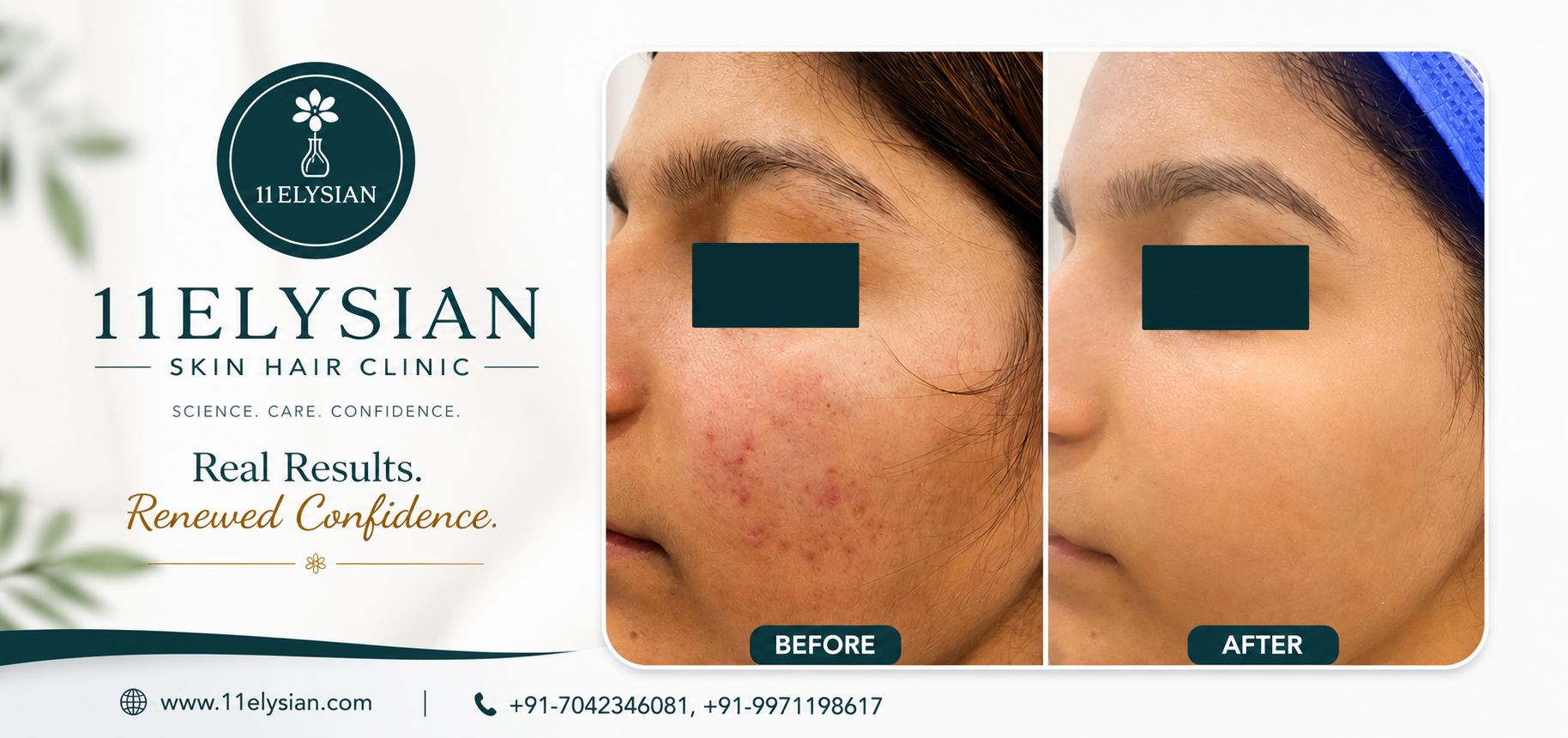 Acne Treatment Clinic Near Sector 107, Noida